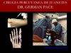 Cirugía percutánea de juanetes Técnica MICA