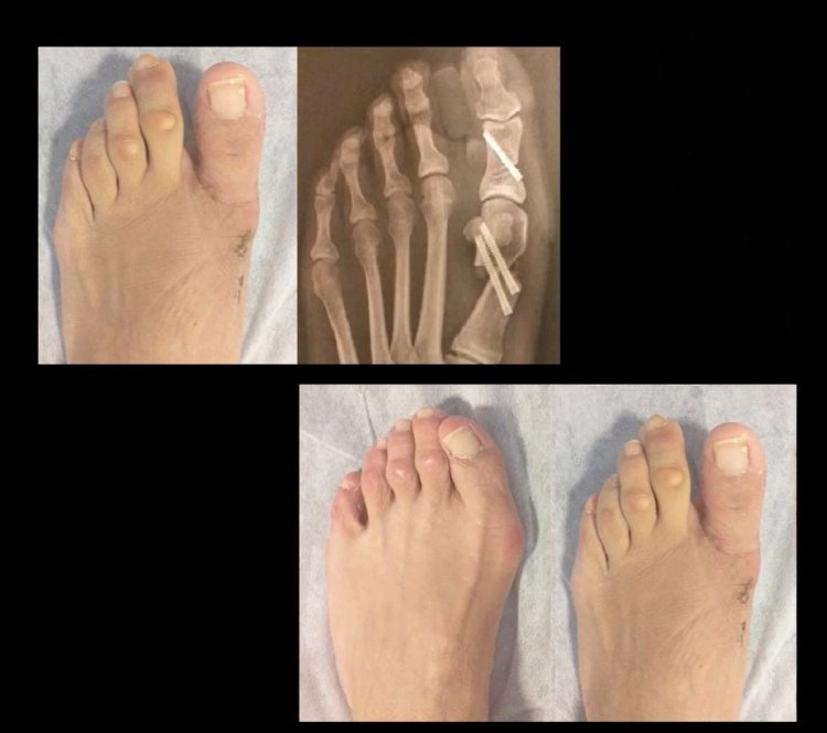 Cirugía percutánea de pies antes y despues