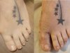 Cirugia Percutanea de Hallux valgus Juanetes