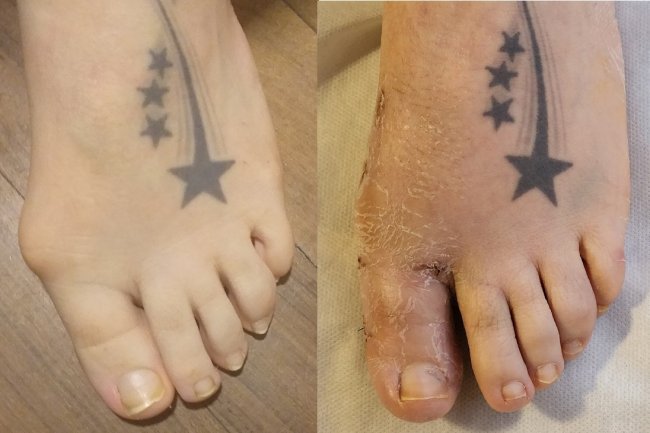 Cirugia Percutanea de Hallux valgus Juanetes